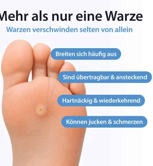 Acetocaustin 20 Warzenpflaster