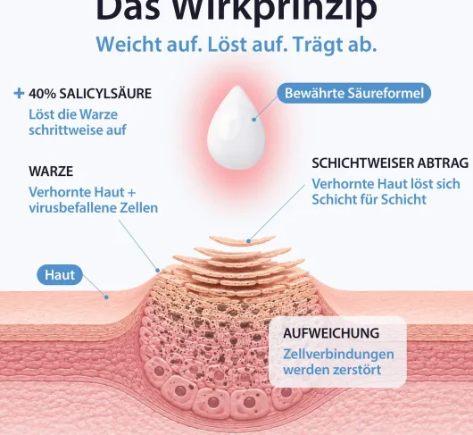Acetocaustin 20 Warzenpflaster